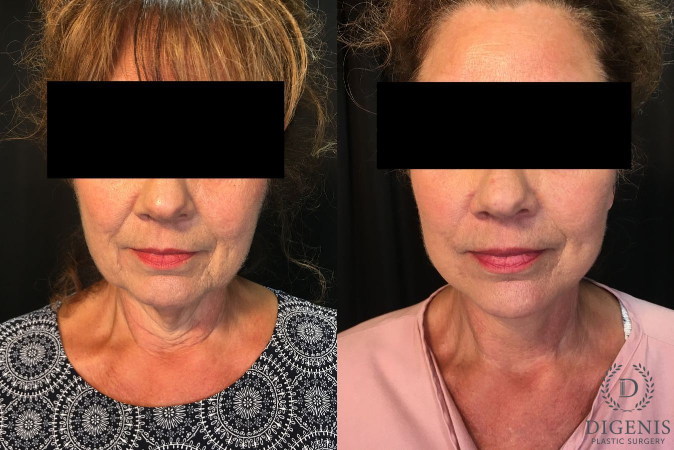 Before and after Face Lift/Neck Lift case 34992