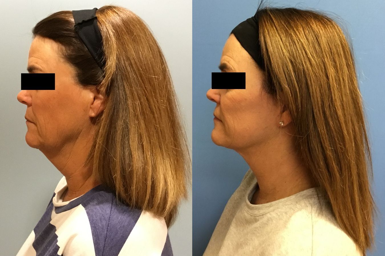Before and after Facelift case 34966 - Angle 5