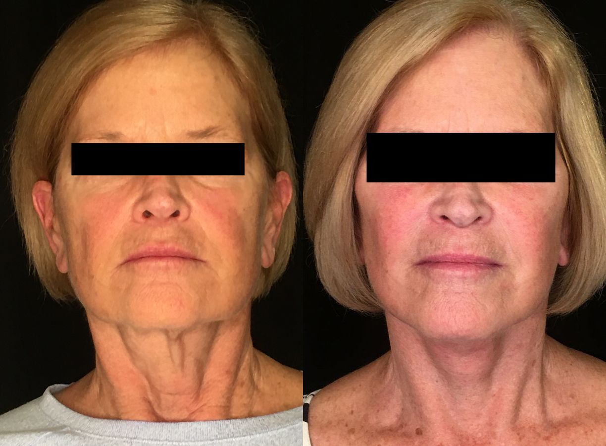 Before and after Face Lift/Neck Lift case 34974