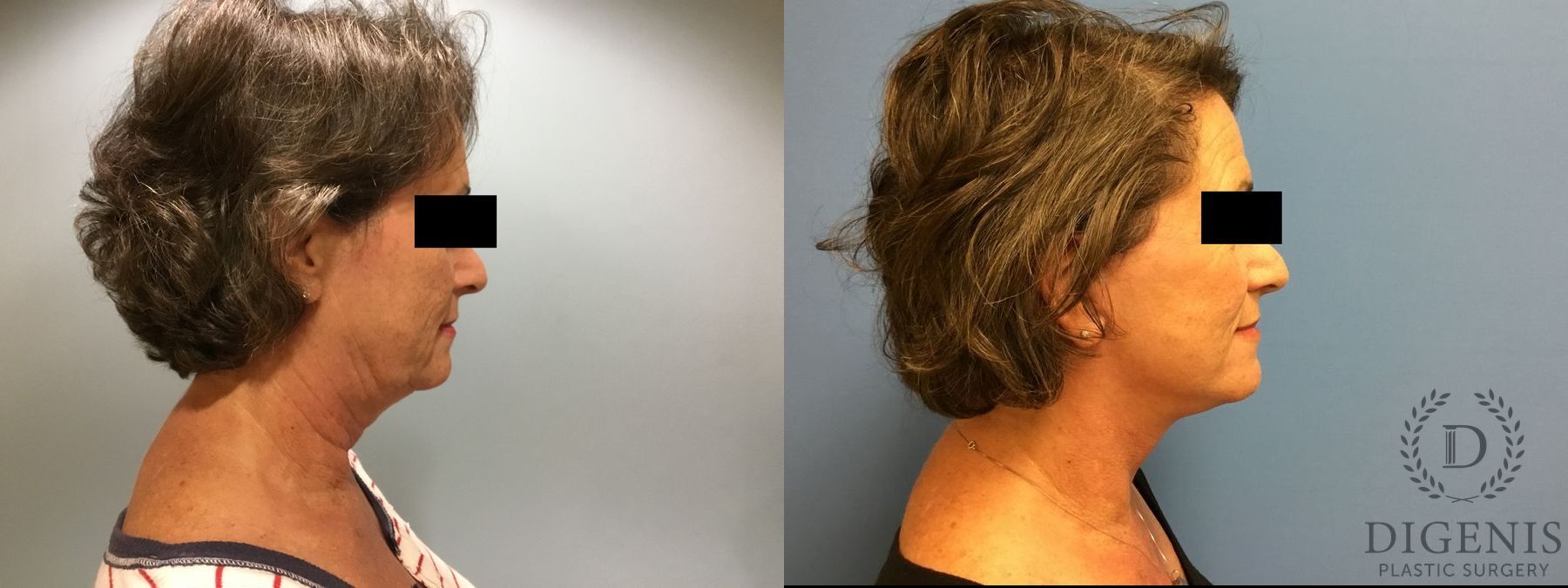 Before and after Face Lift/Neck Lift case 34987 - Angle 3