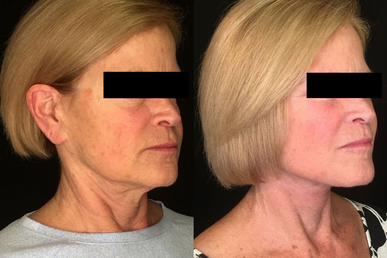 Before and after Face Lift/Neck Lift case 34974 - Angle 2