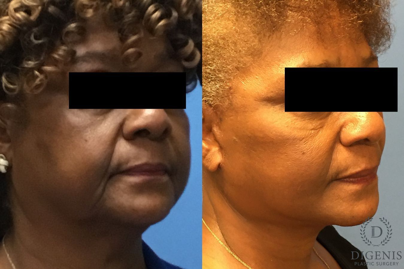 Before and after Facelift case 34959 - Angle 2