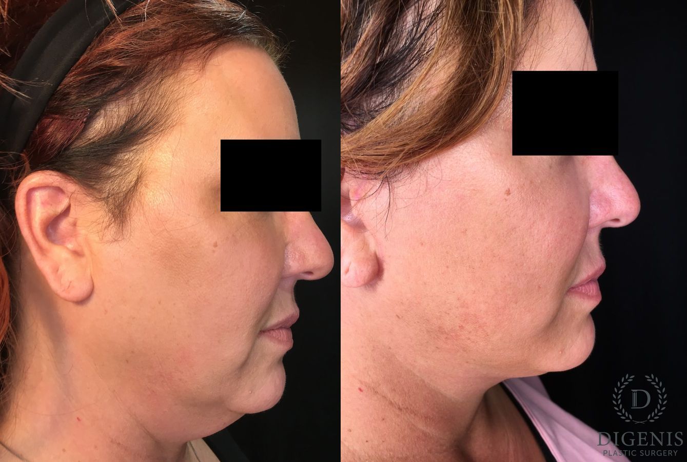 Before and after Face Lift/Neck Lift case 34994 - Angle 3