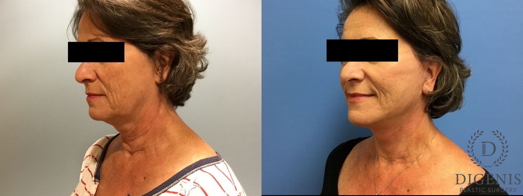 Before and after Face Lift/Neck Lift case 34987 - Angle 4