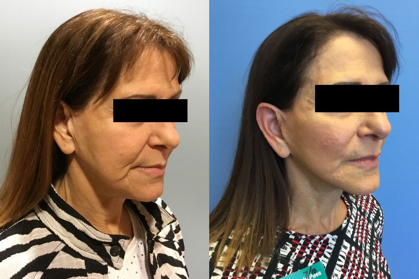 Before and after Face Lift/Neck Lift case 34963 - Angle 2