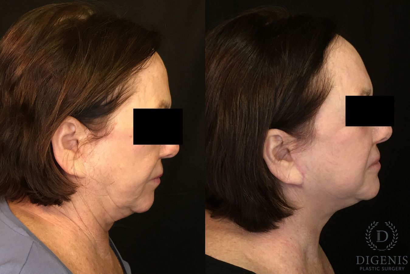 Before and after Face Lift/Neck Lift case 34989 - Angle 3