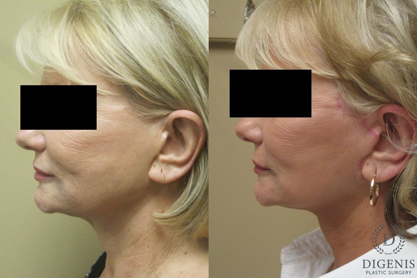 Before and after Face Lift/Neck Lift case 34977 - Angle 5