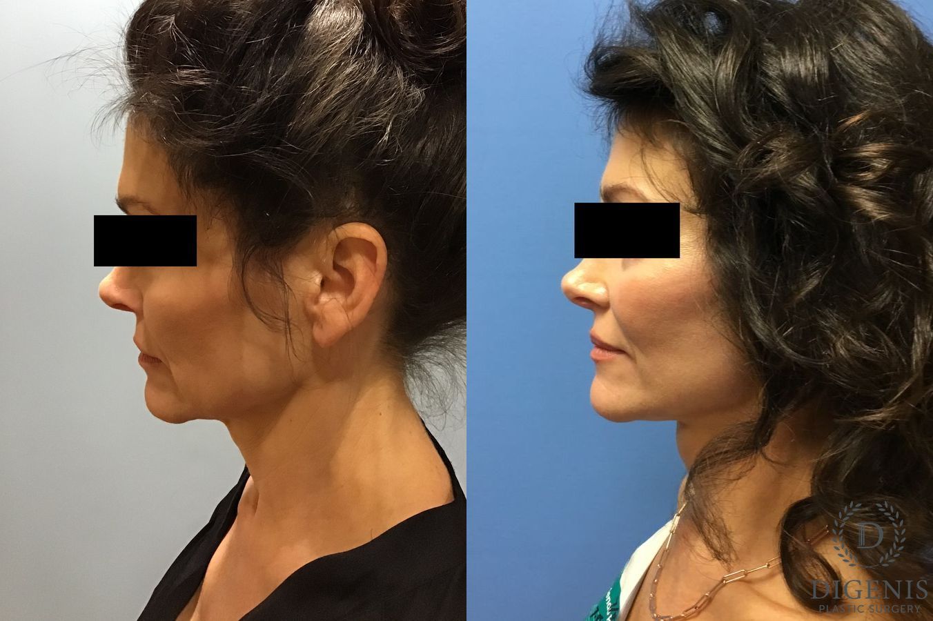 Before and after Facelift case 34982 - Angle 3