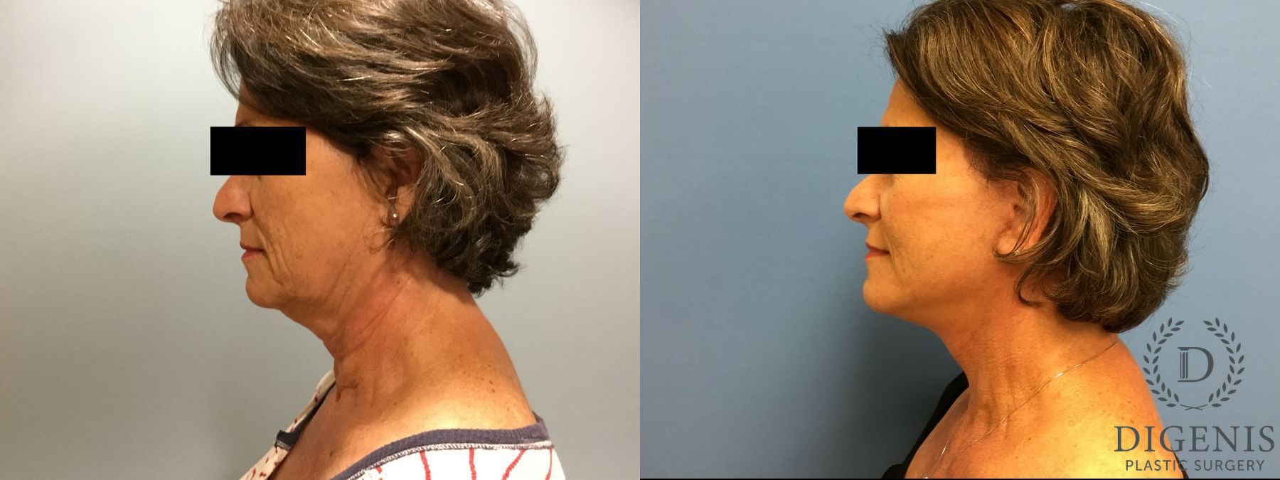 Before and after Face Lift/Neck Lift case 34987 - Angle 5