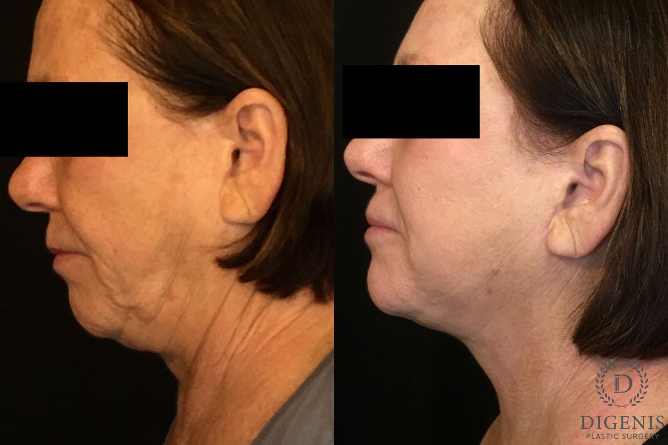 Before and after Face Lift/Neck Lift case 34989 - Angle 5