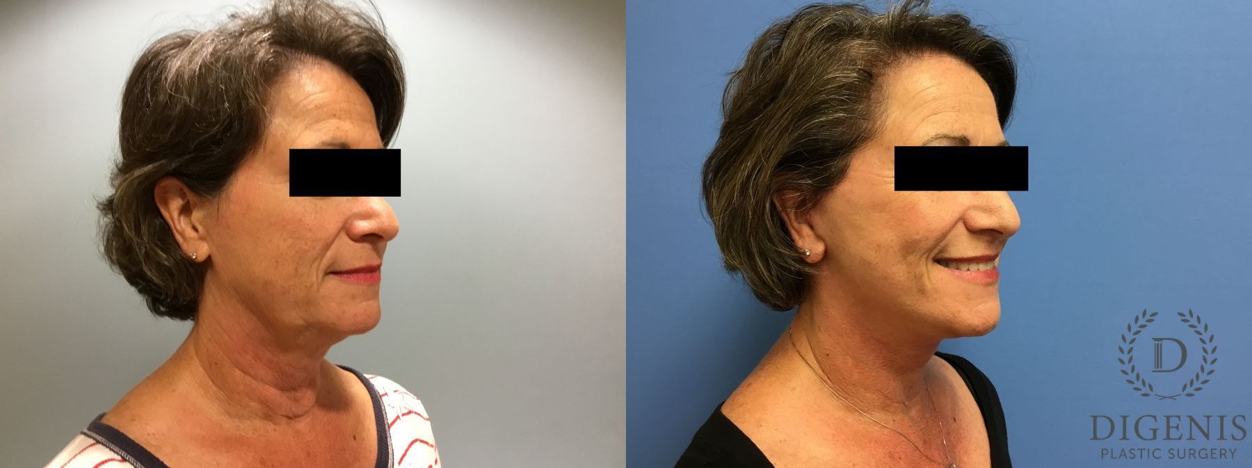 Before and after Face Lift/Neck Lift case 34987 - Angle 2