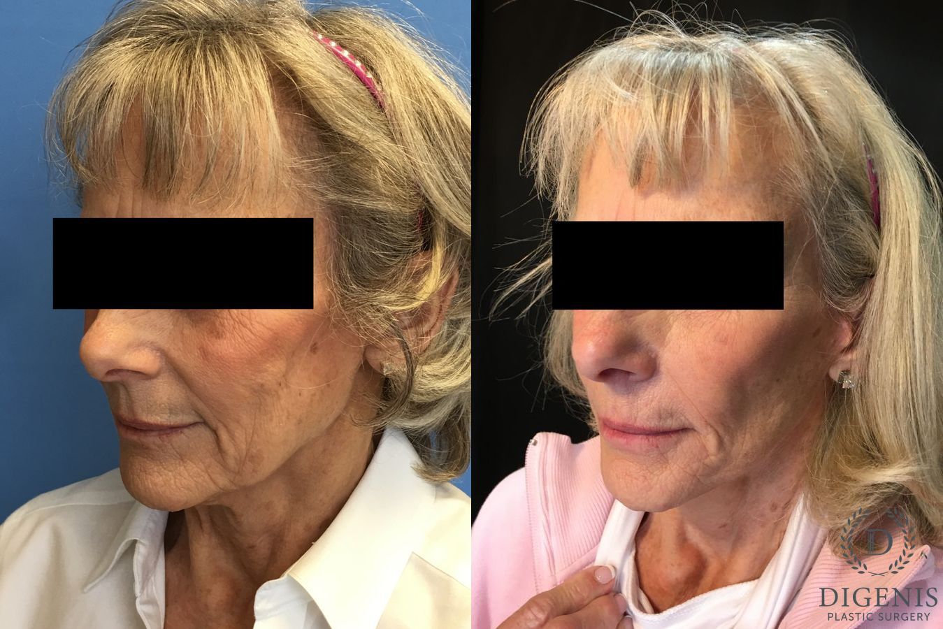 Before and after Face Lift/Neck Lift case 34962 - Angle 3