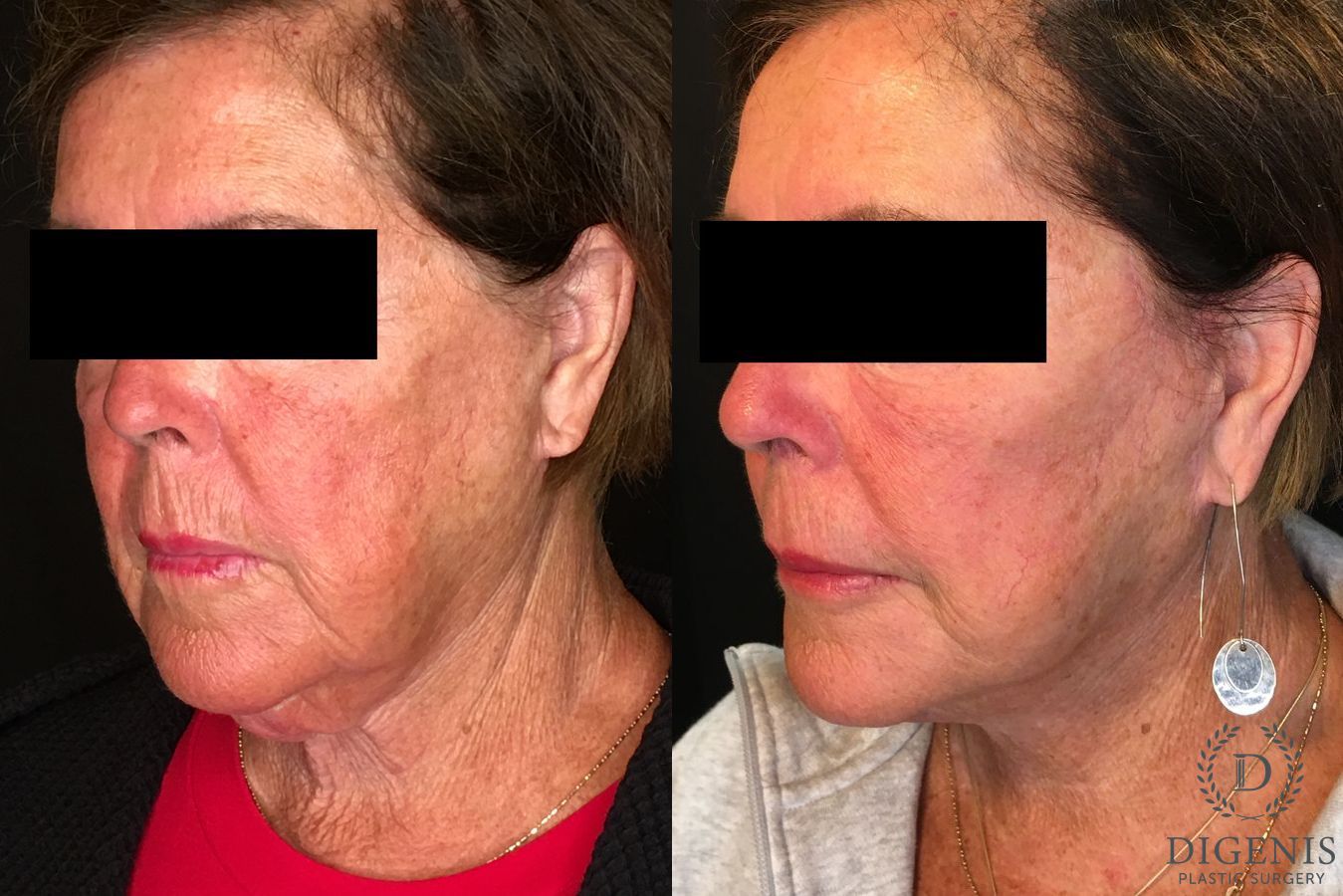 Before and after Face Lift/Neck Lift case 34991 - Angle 4