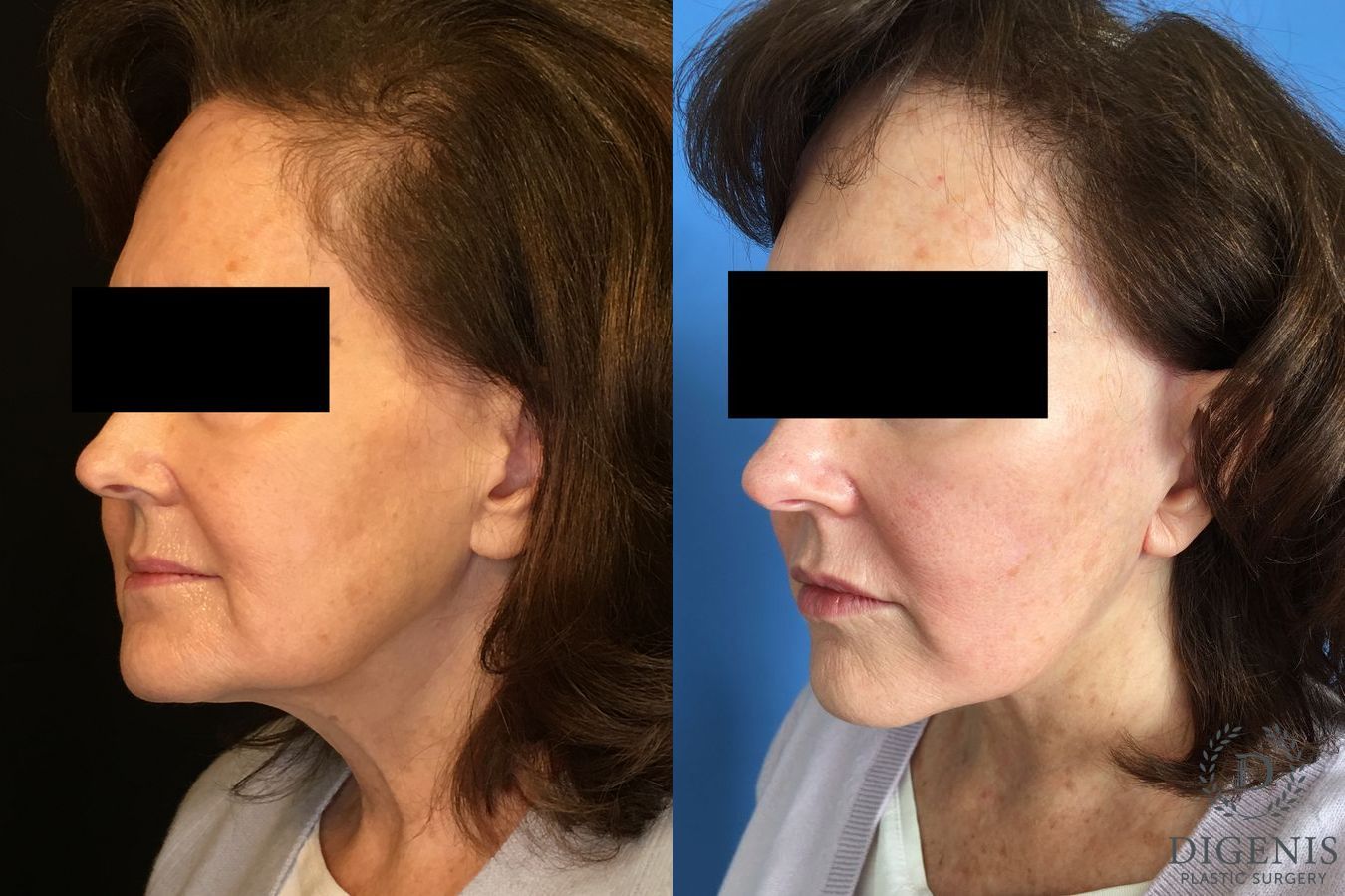 Before and after Face Lift/Neck Lift case 34993 - Angle 3
