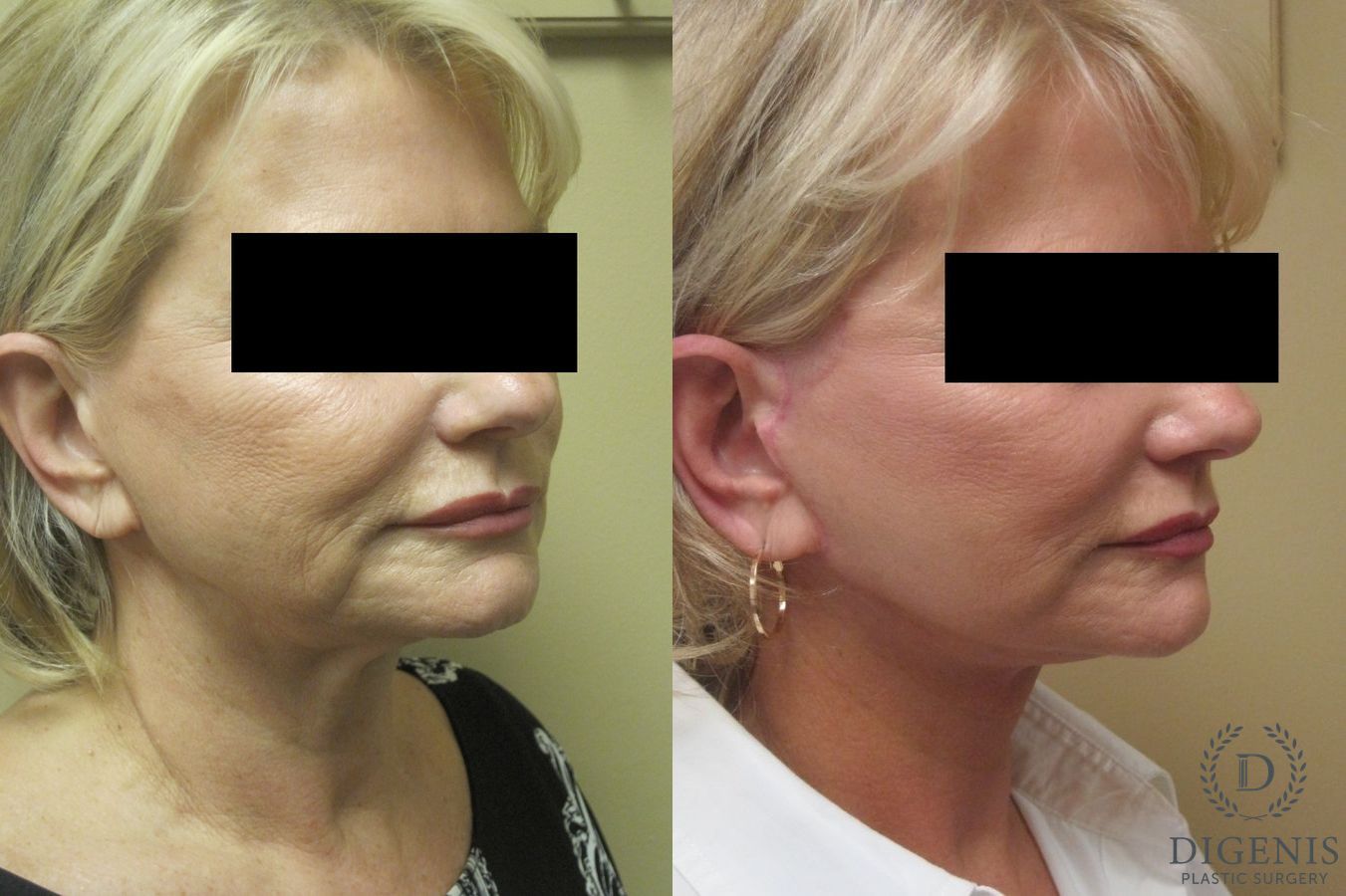 Before and after Face Lift/Neck Lift case 34977 - Angle 2