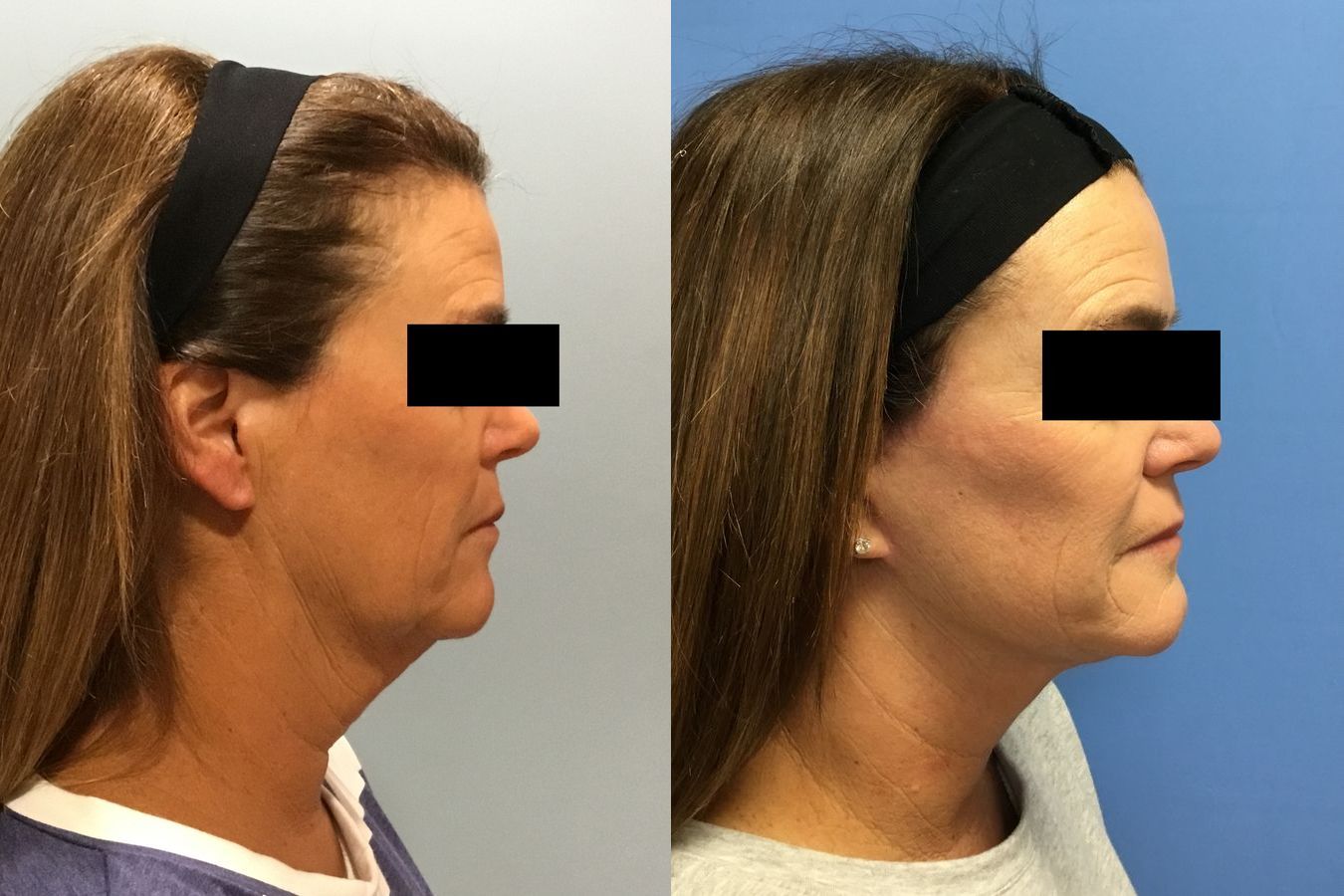 Before and after Facelift case 34966 - Angle 3