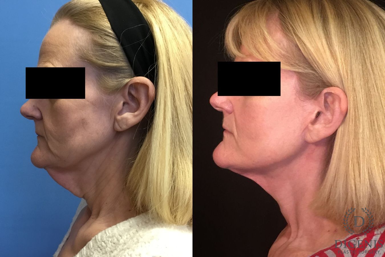 Before and after Facelift case 34964 - Angle 5