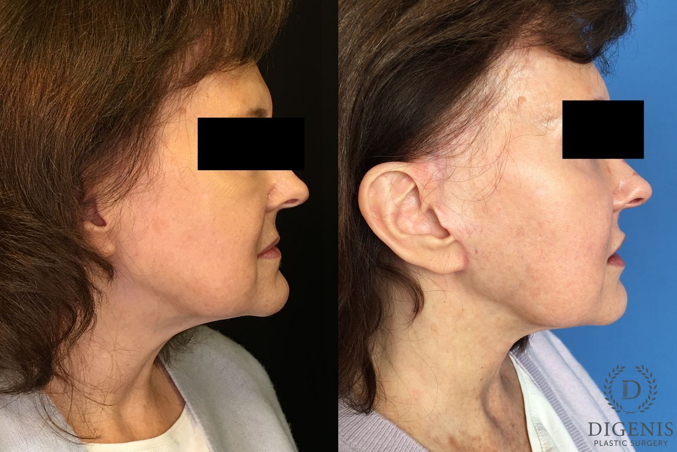 Before and after Face Lift/Neck Lift case 34993 - Angle 2