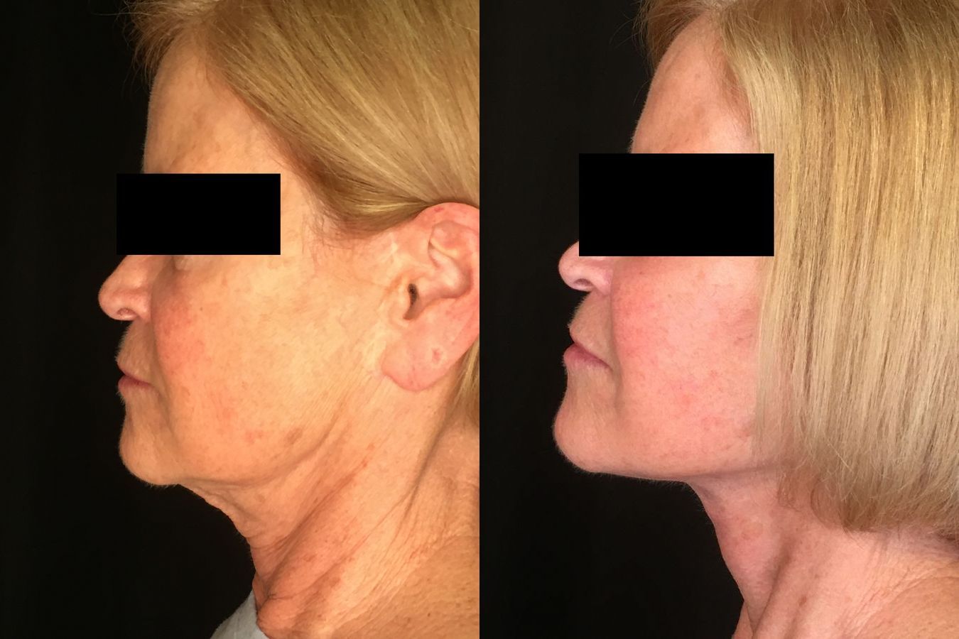 Before and after Face Lift/Neck Lift case 34974 - Angle 5