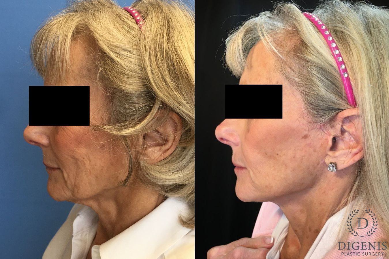 Before and after Face Lift/Neck Lift case 34962 - Angle 4