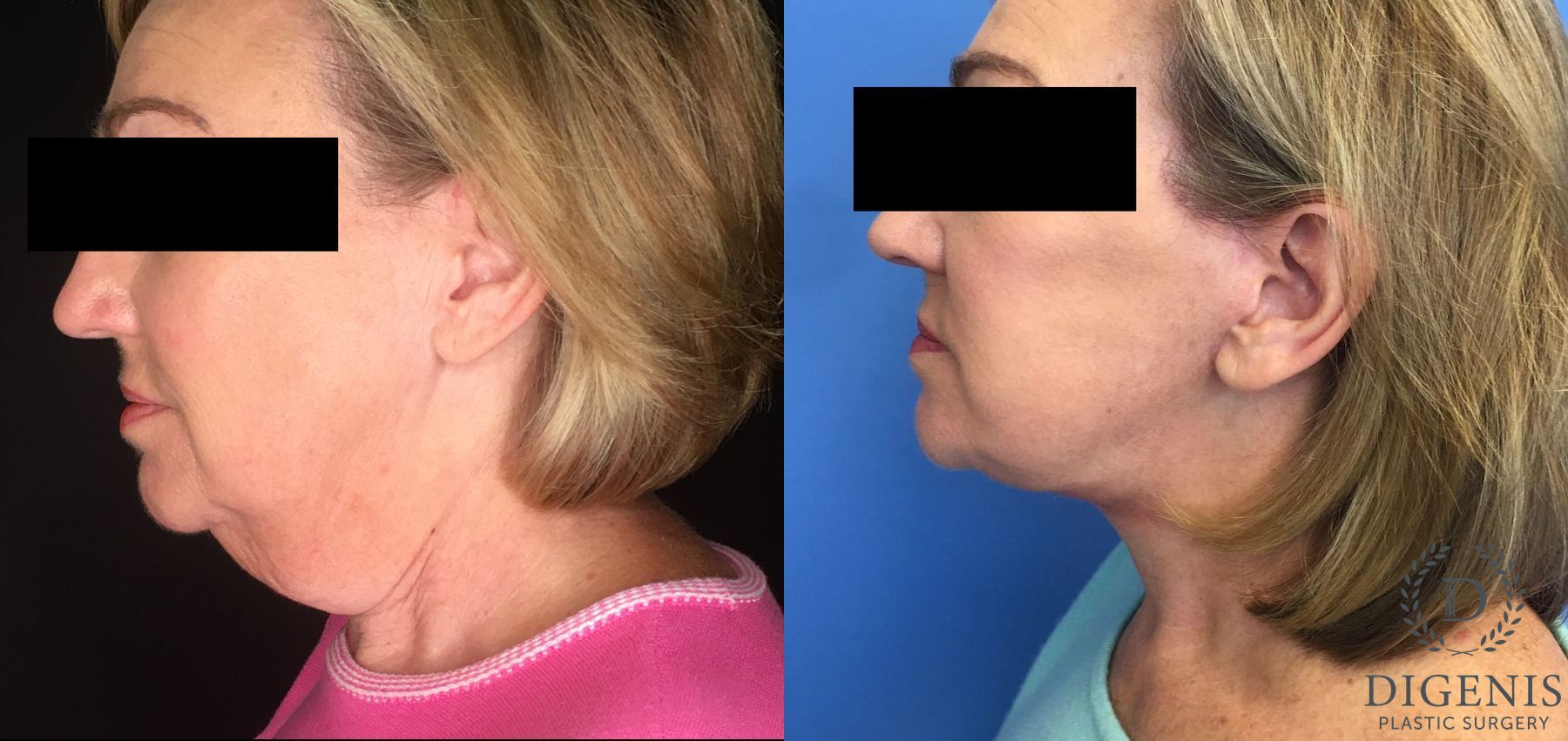 Before and after Facelift case 34969 - Angle 3