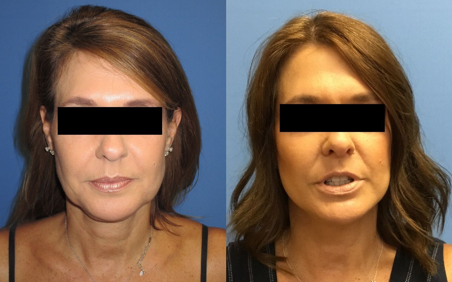 Before and after Facelift case 34978