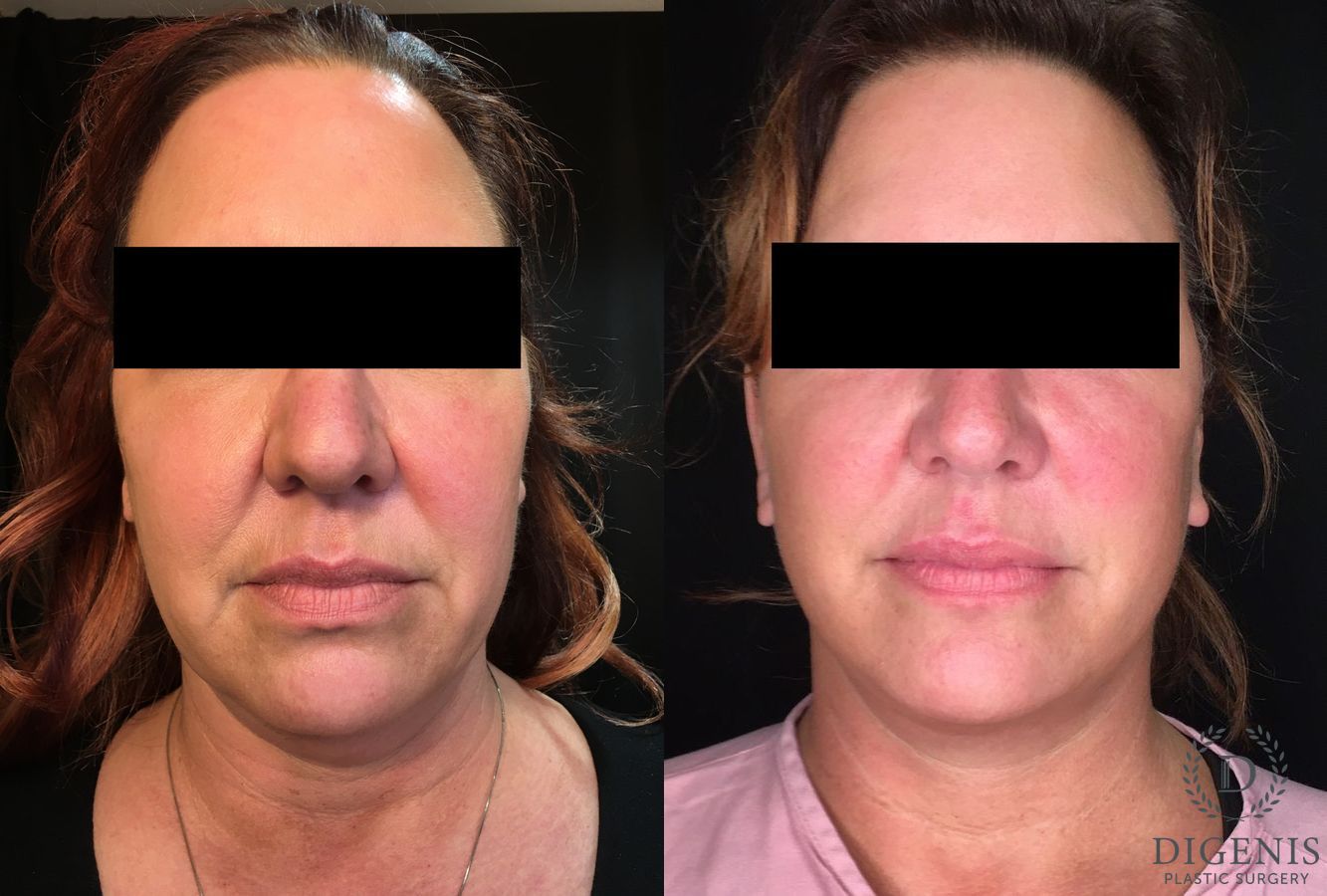 Before and after Face Lift/Neck Lift case 34994