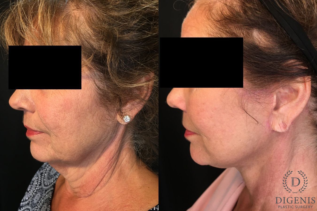 Before and after Face Lift/Neck Lift case 34992 - Angle 4