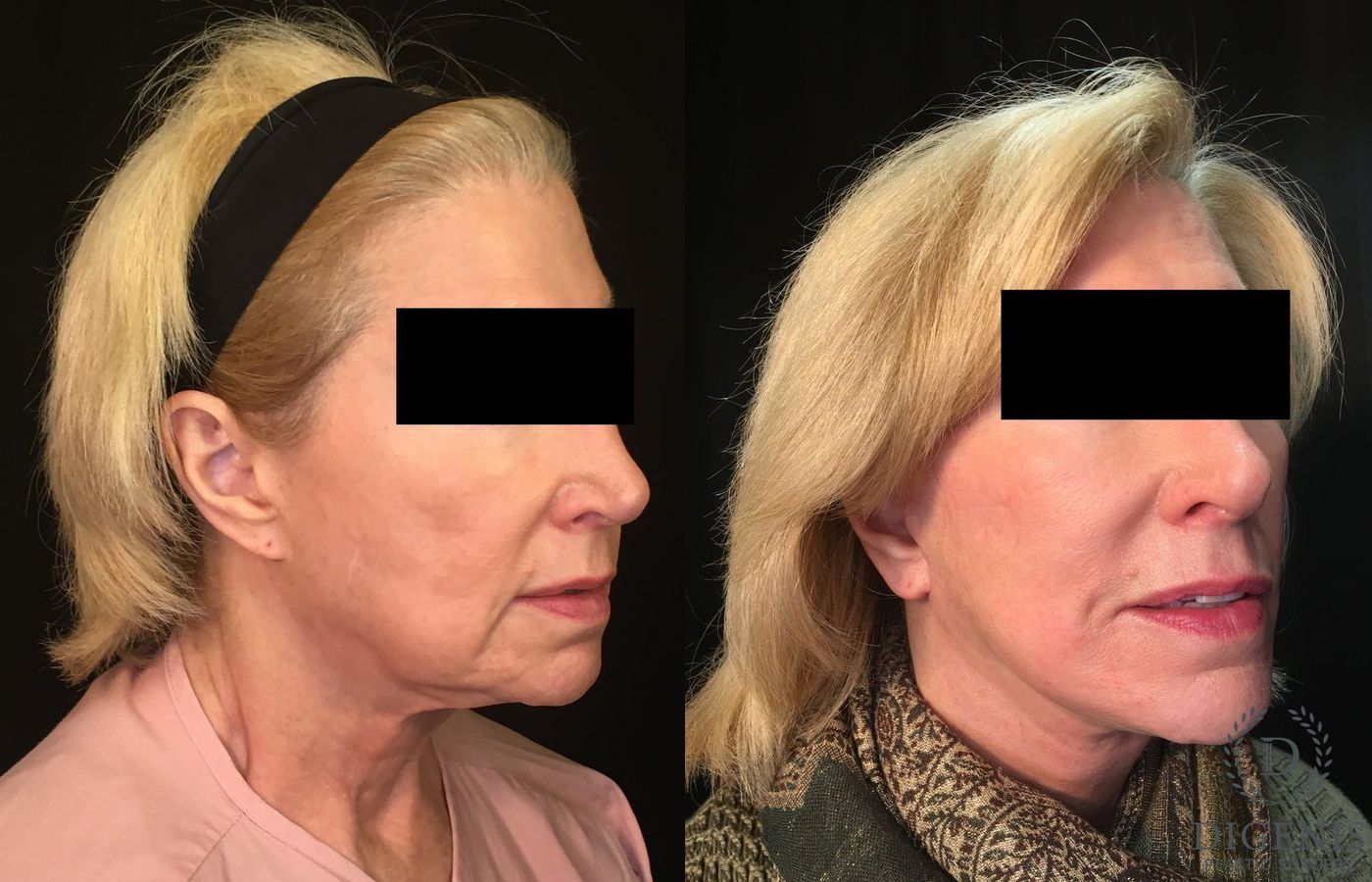 Before and after Face Lift/Neck Lift case 34996 - Angle 2