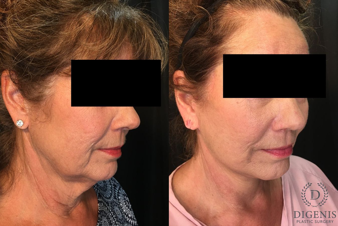 Before and after Face Lift/Neck Lift case 34992 - Angle 2