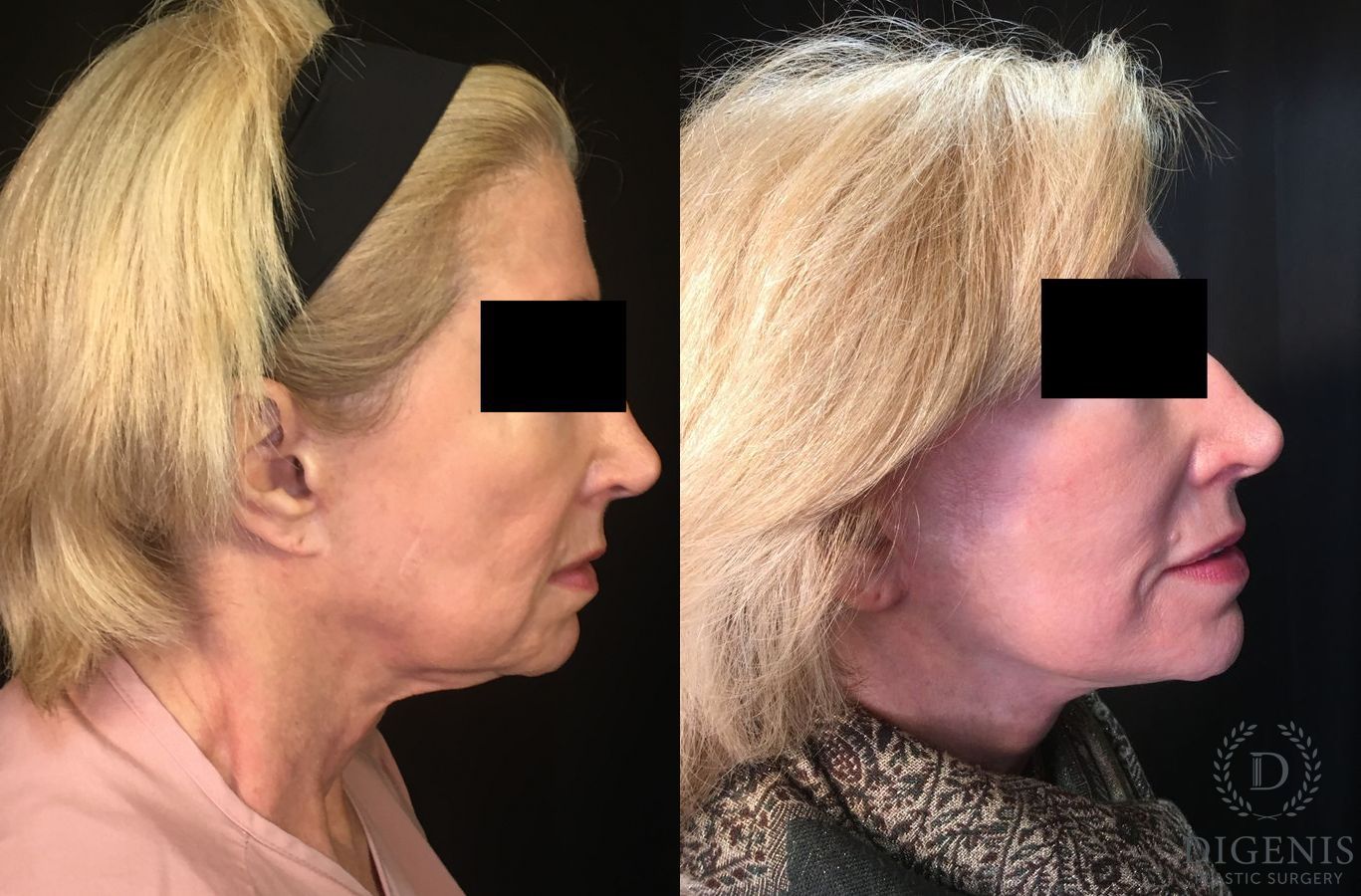 Before and after Face Lift/Neck Lift case 34996 - Angle 3