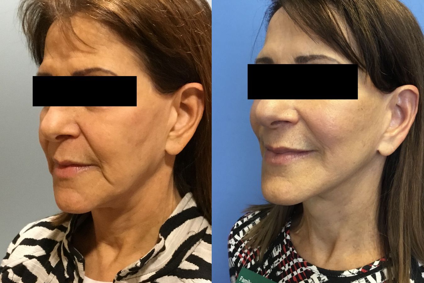 Before and after Face Lift/Neck Lift case 34963 - Angle 4