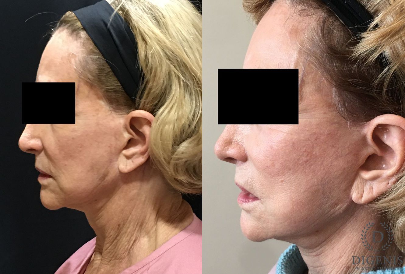 Before and after Facelift case 34985 - Angle 5
