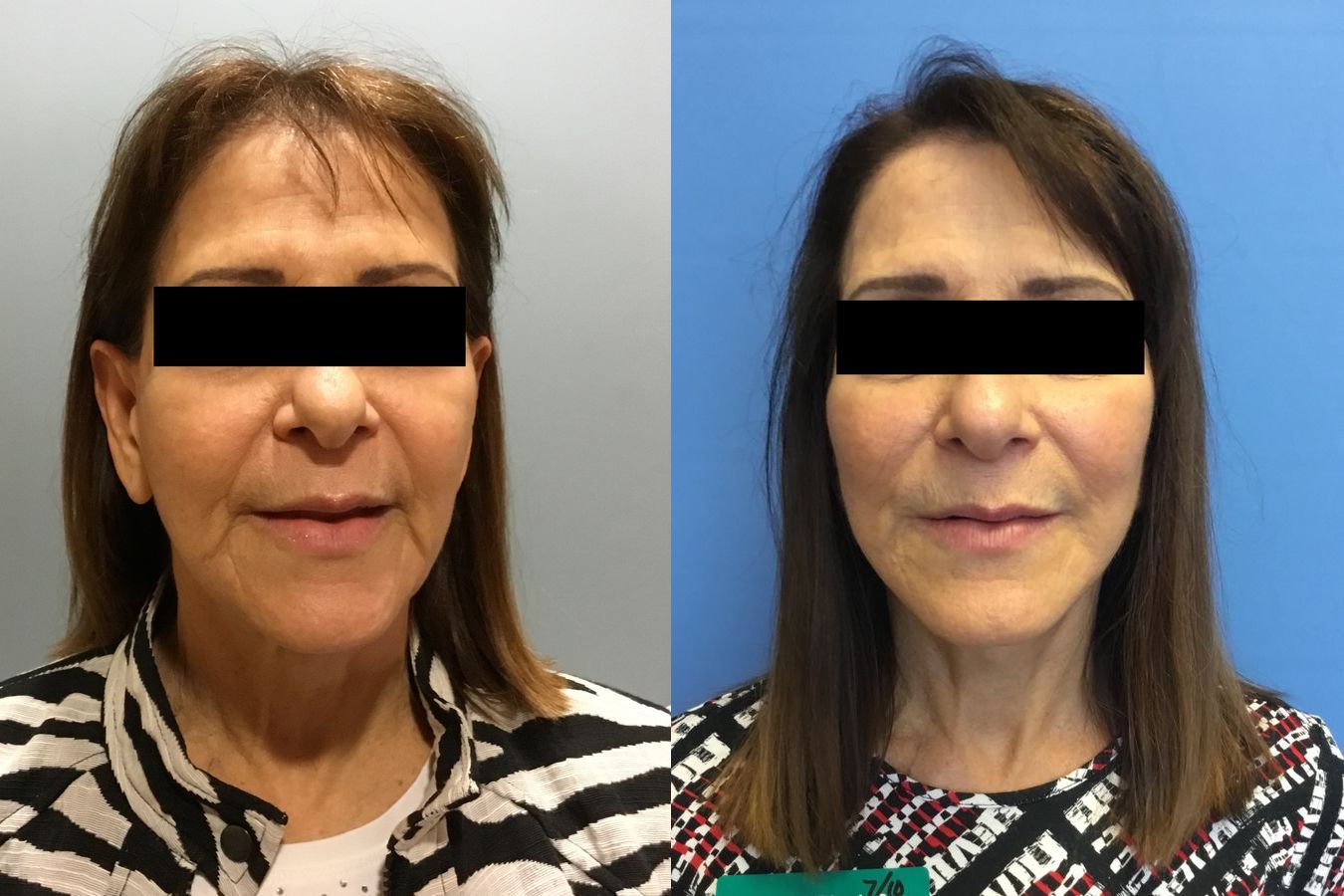 Before and after Face Lift/Neck Lift case 34963