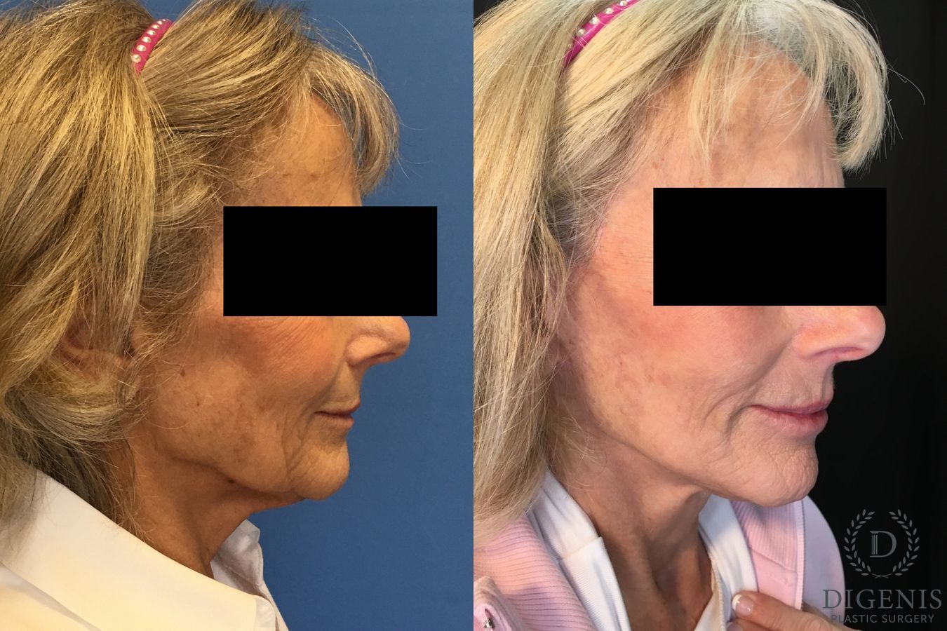 Before and after Face Lift/Neck Lift case 34962 - Angle 2