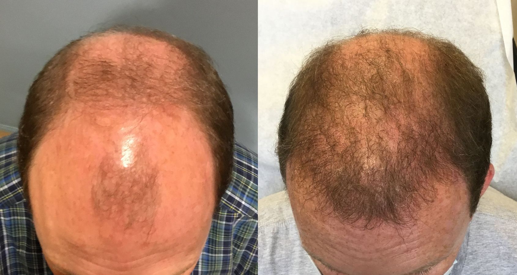 Before and after Hair Loss Treatment case 35085