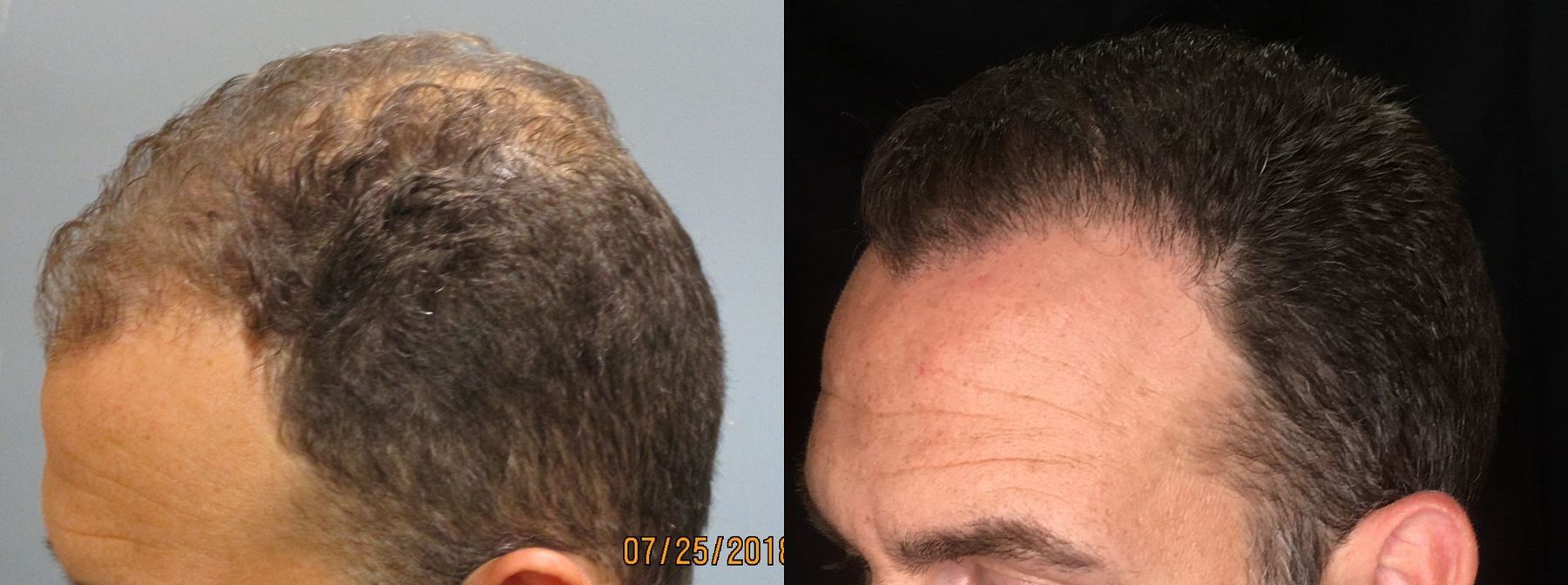 Before and after Hair Loss Treatment case 35079
