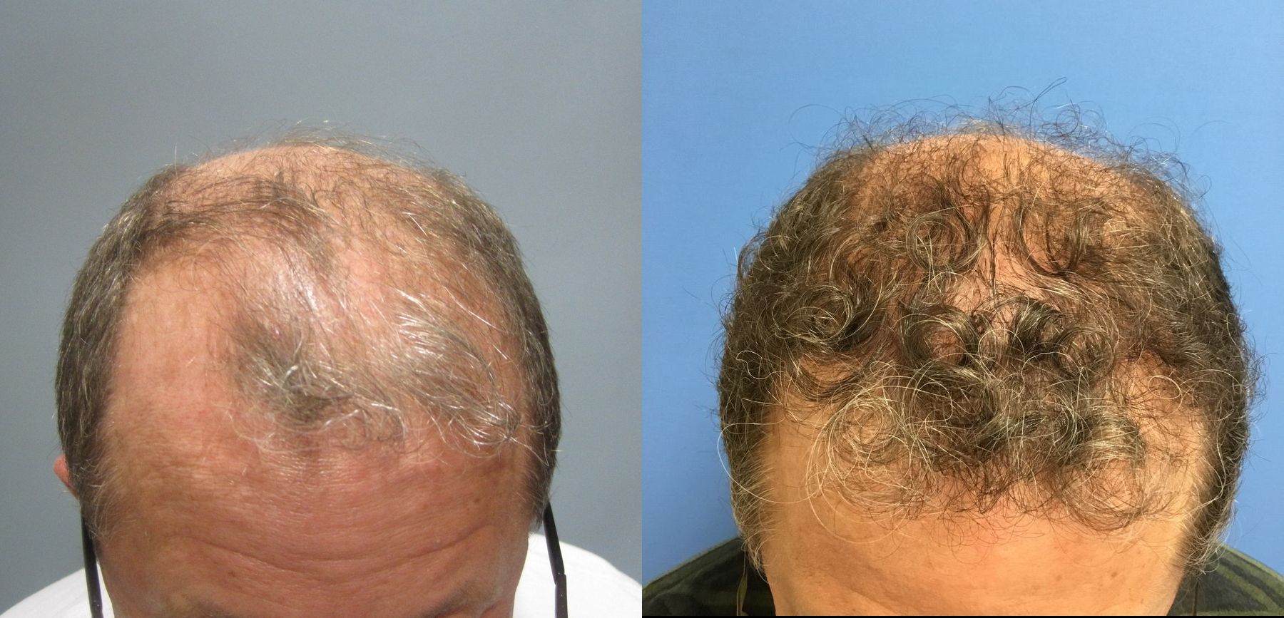 Before and after Hair Loss Treatment case 35078