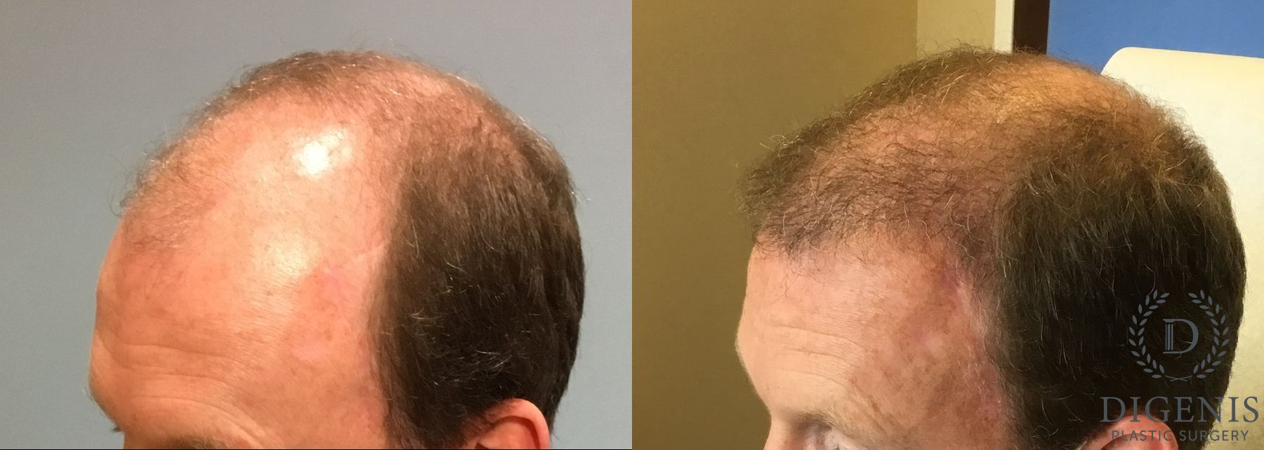 Before and after Hair Restoration/ Hair Thinning case 35085 - Angle 2