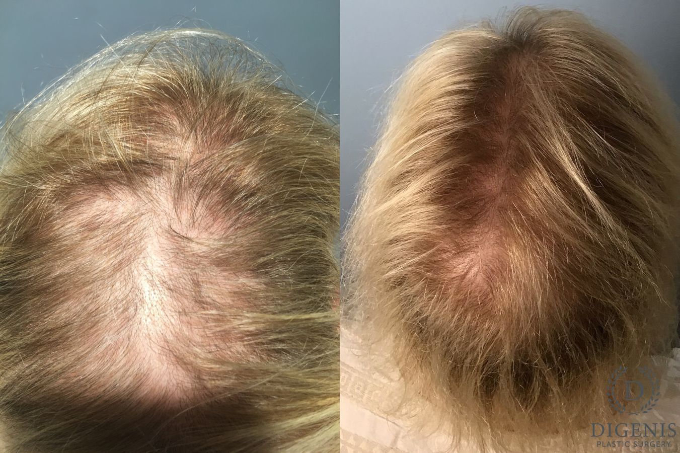 Before and after Hair Restoration/ Hair Thinning case 35257 - Angle 2