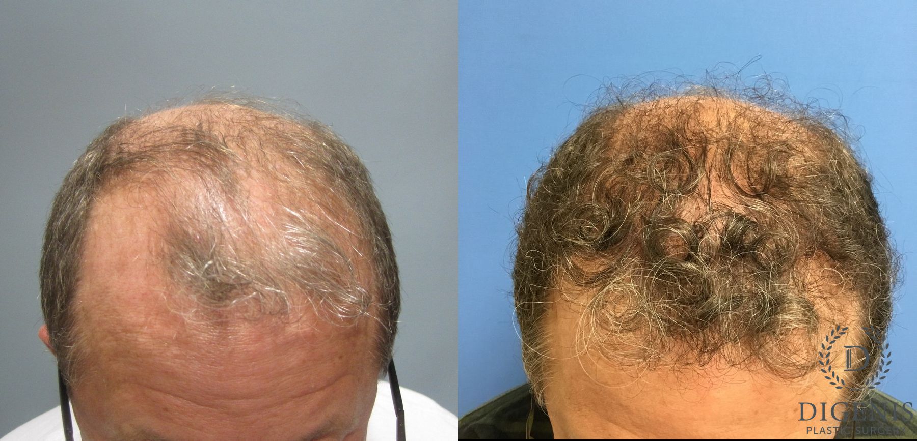 Before and after Hair Restoration/ Hair Thinning case 35078