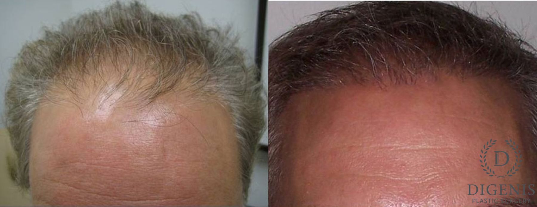 Before and after Hair Restoration/ Hair Thinning case 35037