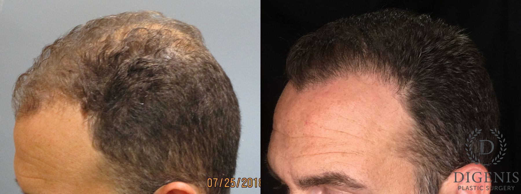 Before and after Hair Restoration/ Hair Thinning case 35079