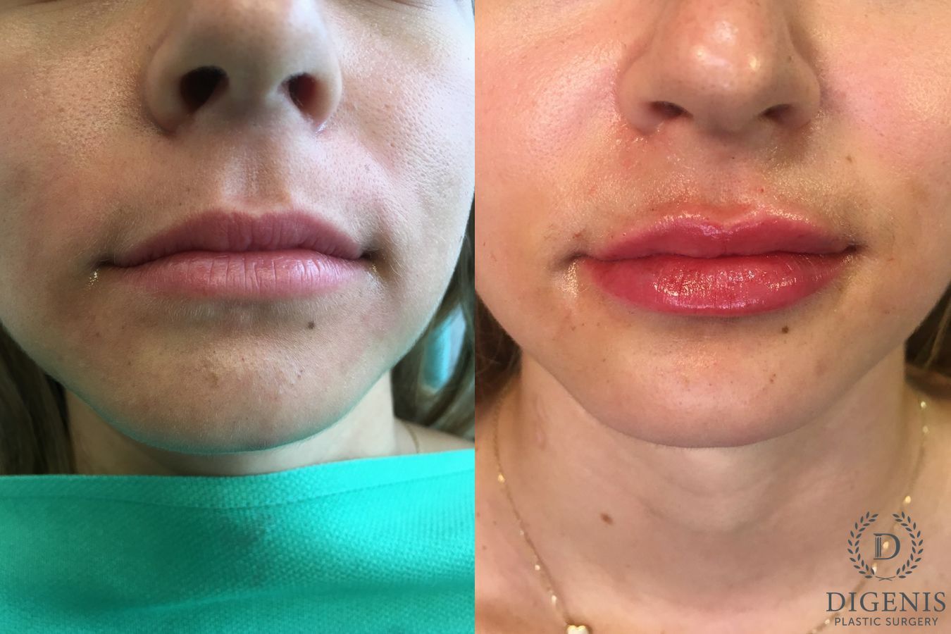 Before and after Injectables case 35121