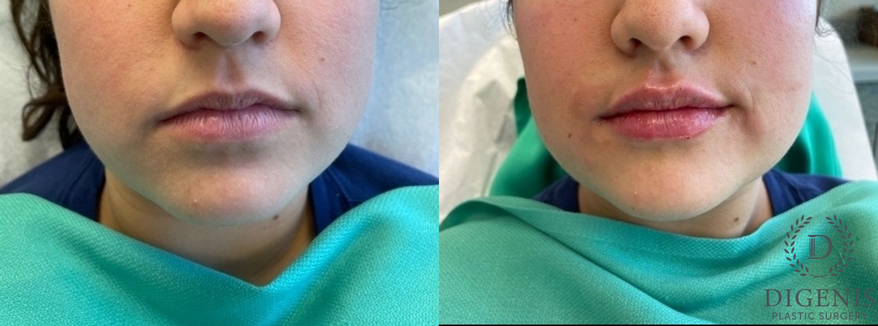 Before and after Injectables case 35077