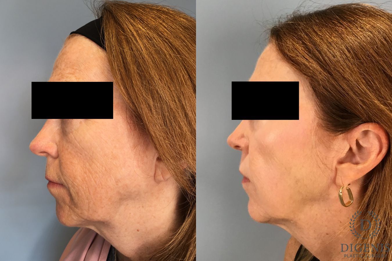 Before and after Laser Skin Resurfacing case 49532 - Angle 3