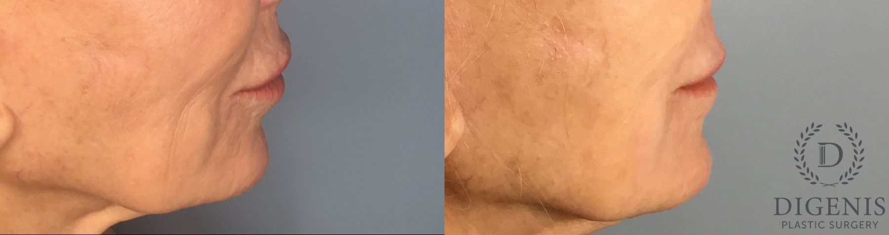 Before and after Laser Skin Resurfacing case 43368 - Angle 5