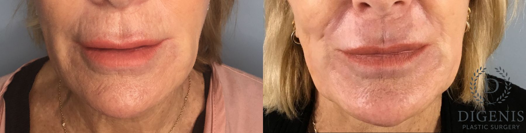 Before and after Laser Skin Resurfacing case 43368
