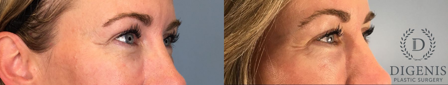Before and after Laser Skin Resurfacing case 41760 - Angle 4