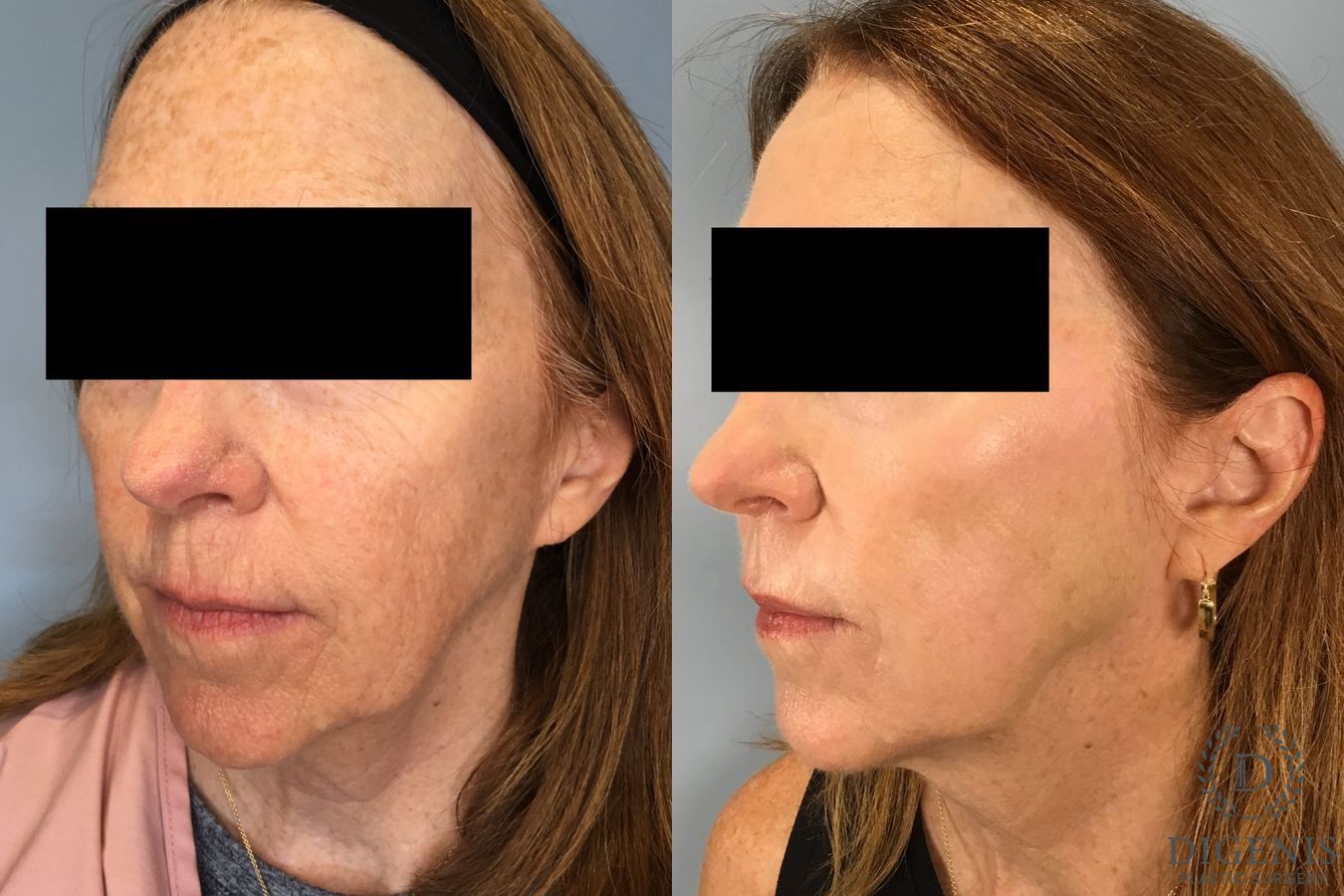 Before and after Laser Skin Resurfacing case 49532 - Angle 2